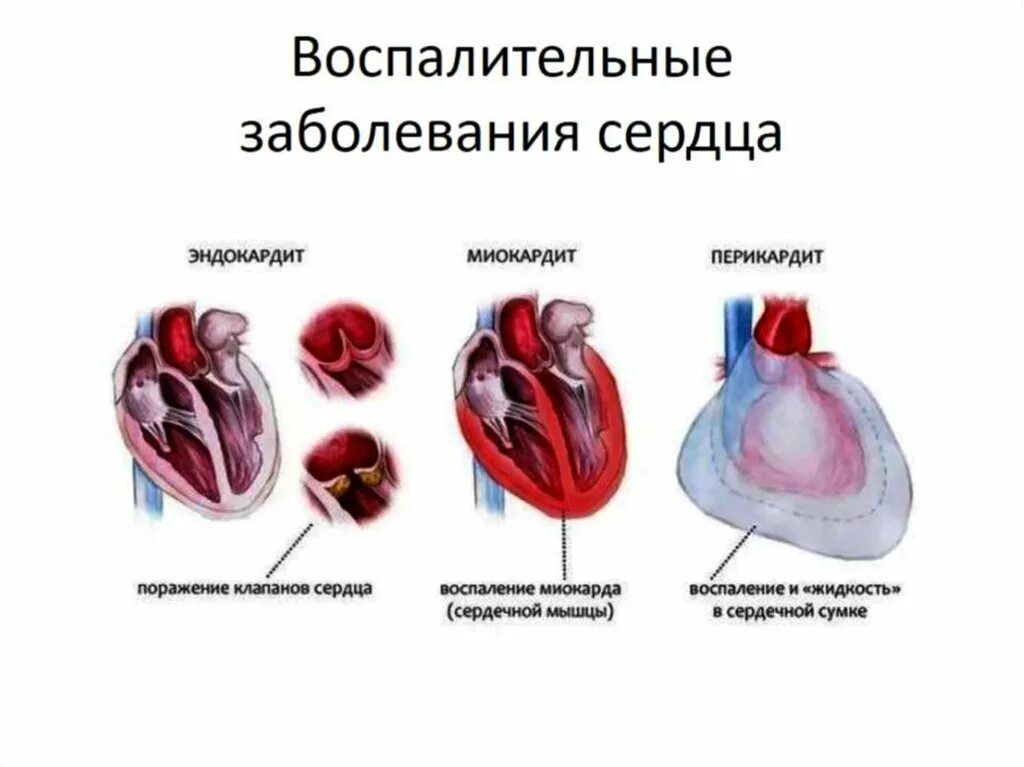 Миокард латынь. Эндокардит миокардит перикардит. Воспалительные заболевания сердца эндокардит миокардит перикардит. Воспалительные процессы в сердце таблица эндокардит. Болезни клапанов сердца:болезни клапанов сердца.