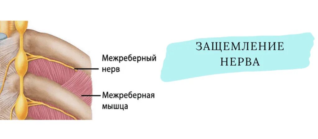 Как отличить межреберную. Межребреная неврология. Межреберный нерв. Межреберная невралоги. Правосторонняя межреберная невралгия.