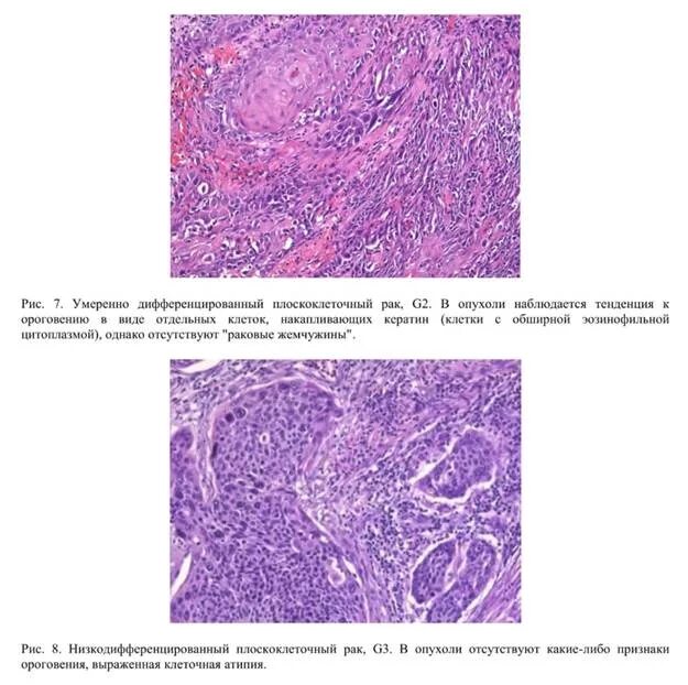 Переходно клеточная карцинома мочевого пузыря гистология. Уротелиальная папиллома микропрепарат. Аденокарцинома предстательной железы гистология. Уротелиальная карцинома гисто. Умеренно дифференцированный плоскоклеточный рак
