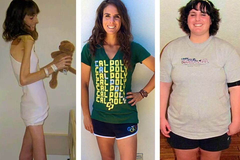 последствия анорексии. похудение в старости. девушки до и после анорексии. болезнь похудевших. анорексия до и после похудения.