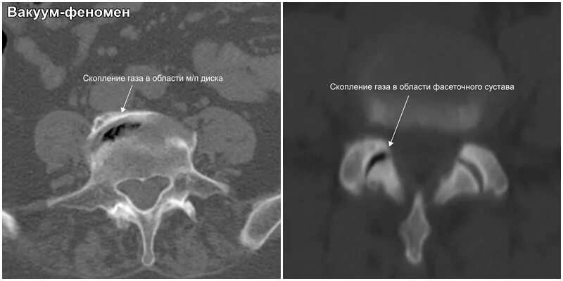 Вакуум феномен диска l5-s1. Вакуум-эффект межпозвоночного диска на кт. Обызвествление межпозвонкового диска рентген. Вакуум симптом. Вакуум симптом.