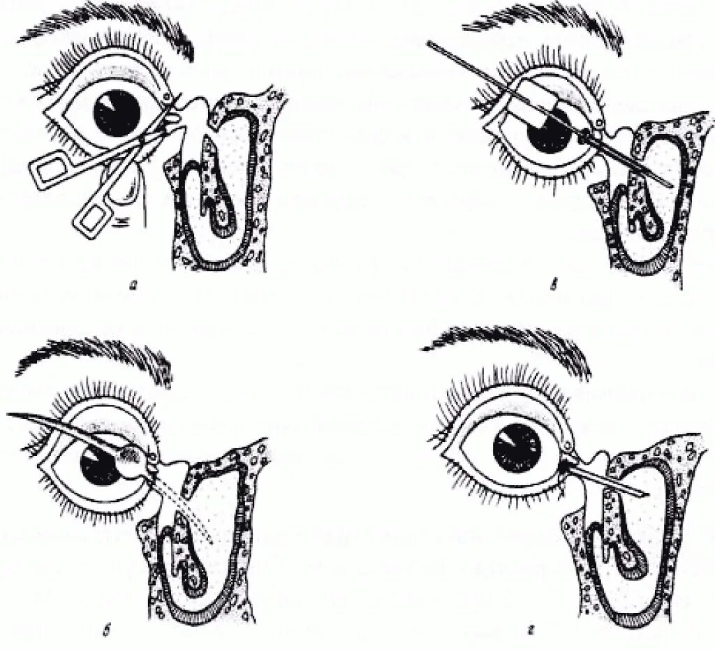 Массаж глаз слезного канала. Воспаление слезного мешка (дакриоцистит). Вскрытие флегмоны слезного мешка. Дакриоцистит риностомия.