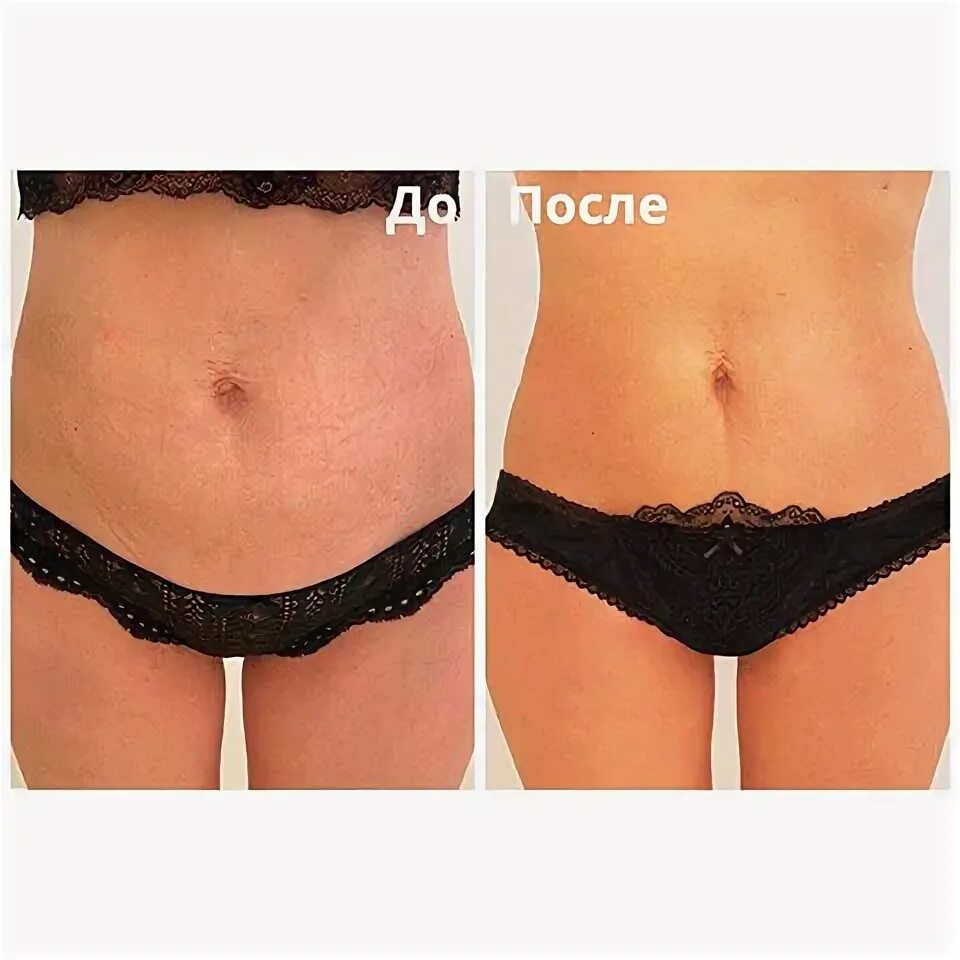 Ультразвуковая липосакция ulfit. Emsculpt до и после. Ulfit липосакция отзывы. Лазерная кавитация липолиз. Эндосфера до и после фото.
