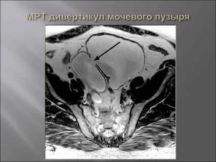 Мрт мочевого