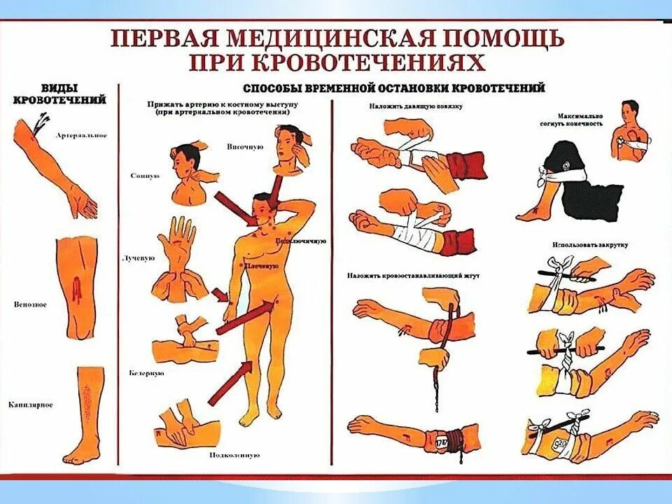 Первая доврачебная помощь при артериальном. Пмп остановка кровотечения. пмп при артериальном кровотечении. порядок первой помощи при кровотечении. схема оказания первой помощи при кровотечениях.