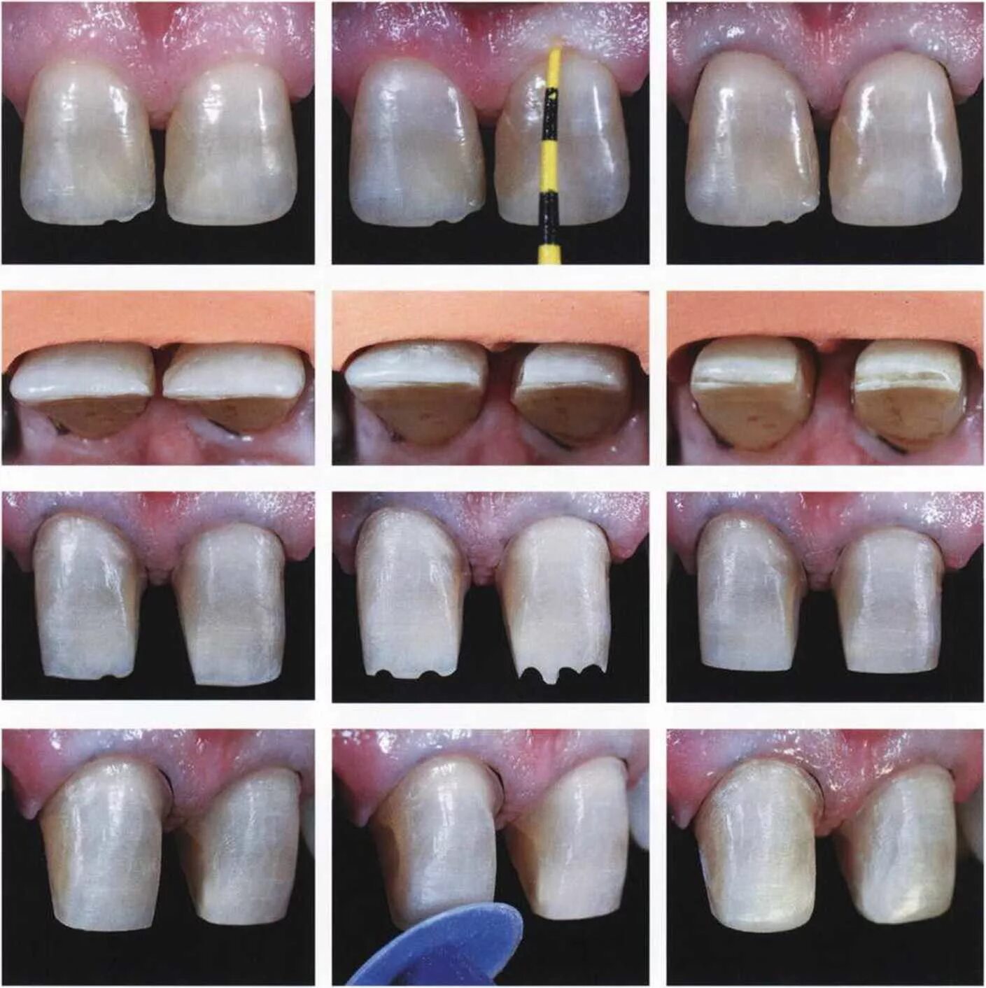 Soon the holiday, and to engage in the "restoration" of teeth is not the time, n