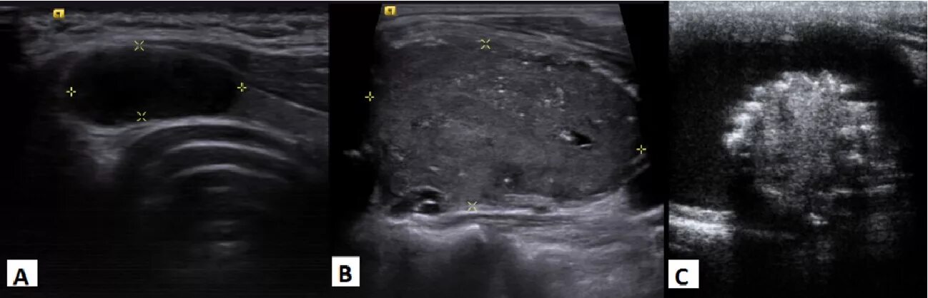 Кистозно-Солидное образование щитовидной железы УЗИ. Кистозные образования в щитовидной железе по УЗИ. Кистозный узел щитовидной железы на УЗИ. Солидные образования щитовидной железы на УЗИ.