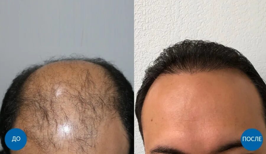 Клиника пересадки волос отзывы. Пересадка волос в Турции. Операция по пересадке волос.