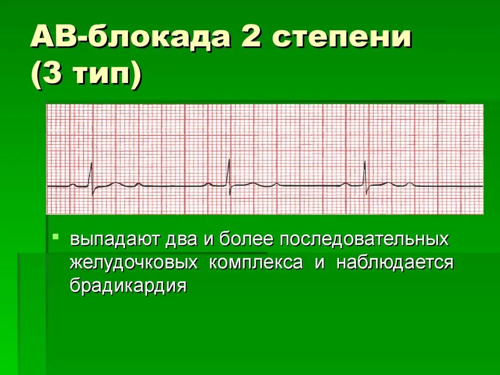 Атриовентрикулярная блокада 2. АВ блокада 2 степени Мобитц 3 на ЭКГ. АВ блокада 2 ст на ЭКГ. Av блокада 2 степени Тип 2 Мобитц 2. АВ блокада 2 ст 2 типа на ЭКГ.