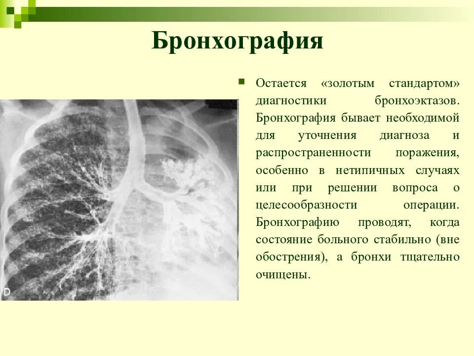 Бронхит бронхоэктатическая болезнь. Хронический бронхит бронхография. Бронхоэктатическая болезнь бронхография. Бронхография бронхоэктазы признаки.