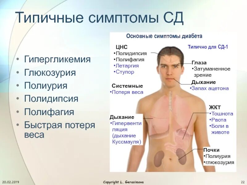 Основные симптомы СД. Типичный симптом СД. Полиурия – полидипсия – глюкозурия – гипергликемия. Гипергликемия симптомы.