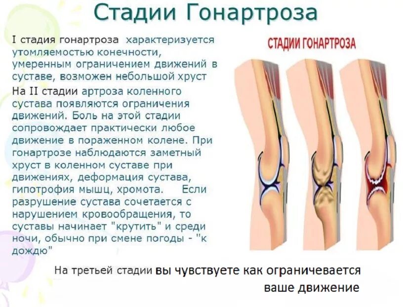 Гонартроз коленного сустава 3 степени снимки. Деформация сустава гонартроз. Остеоартроза коленного сустава 1, 2, 3 степени. Деформирующий гонартроз коленного сустава 2-3 степени.