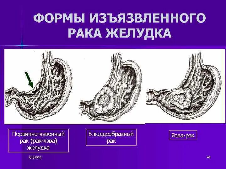 Язвенная болезнь желудка -стадии формирования язвы. Опухолевые новообразования ЖКТ. Язвенная опухоль желудка. Язвенная опухоль схема.