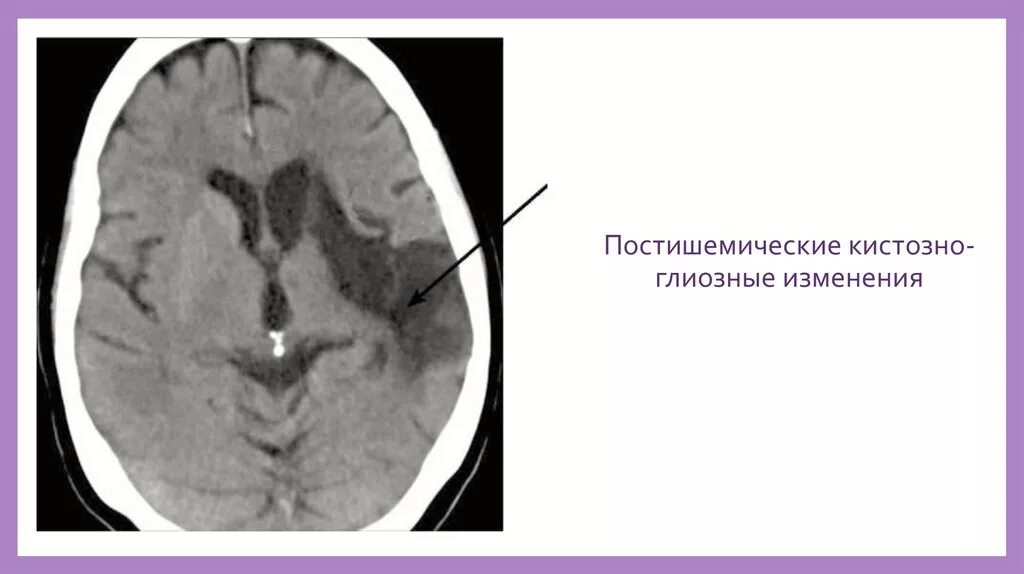 Постишемические изменения мозга. Кистозно-глиозные изменения. Постишемические кистозно-глиозные изменения. Кистозно-глиозные изменения головного мозга что это. Кистозно-глиозные изменения на кт.