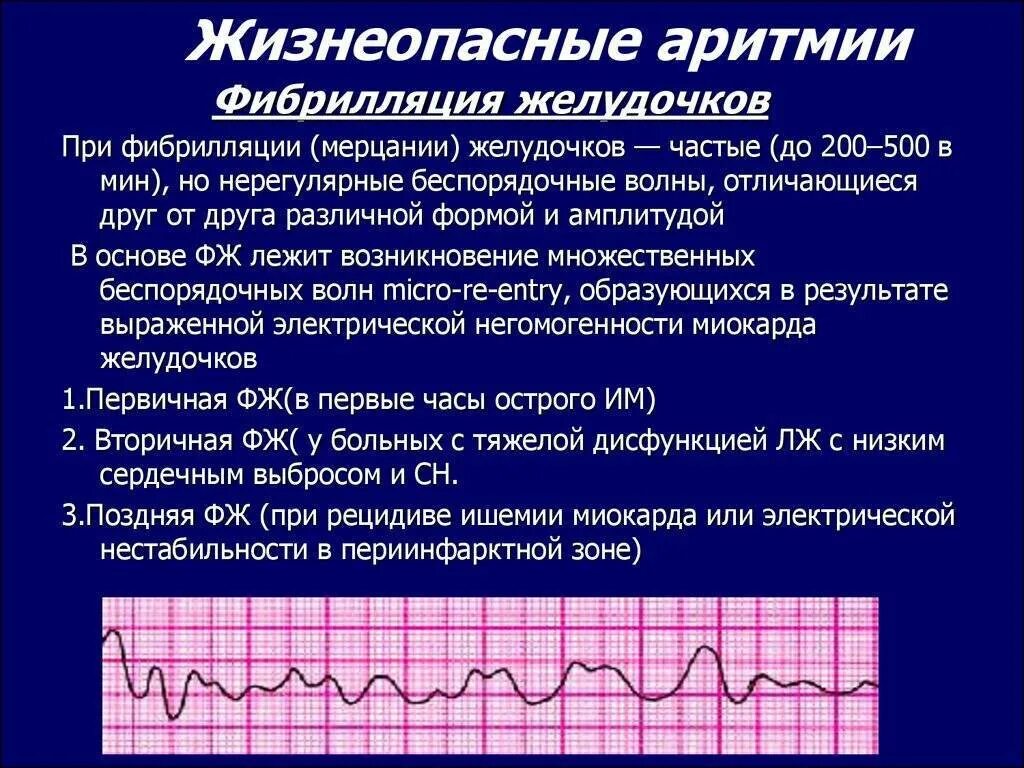Аритмия норма пульса. Синусовая мерцательная аритмия экг. фибрилляция желудочков сердца на экг. мерцательная аритмия симптомы. мерцательная аритмия и желудочковая экстрасистолия.