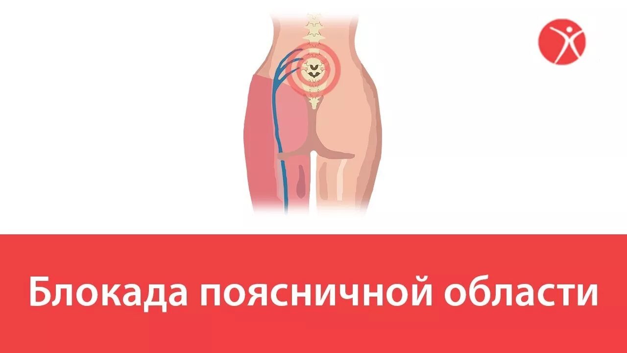 Блокада уколов от боли в спине. Блокада при болях в спине. Блокада позвоночника при грыже. Блокада поясничной области.