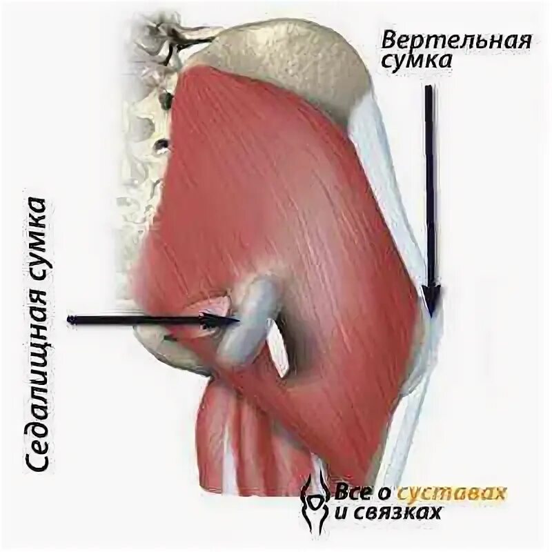 Перитрохантерит тазобедренного сустава. Трохантерит анатомия. Вертельный бурсит трохантерит. Трохантерита тазобедренного сустава. Трохантерит бедренной кости.