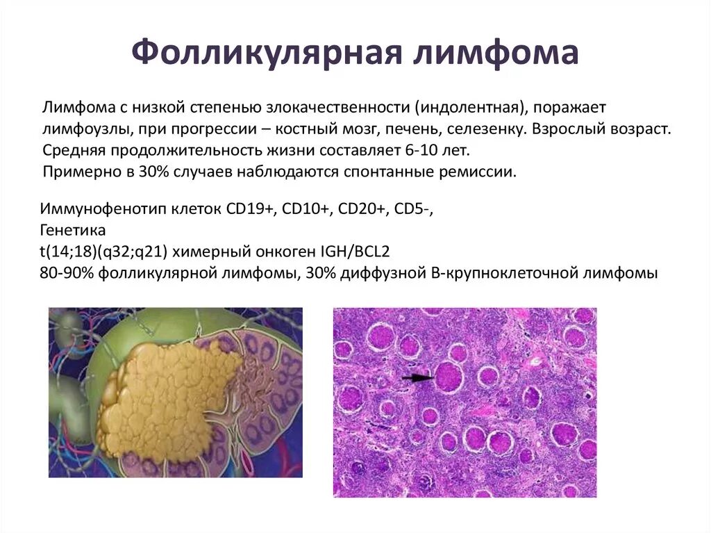 Диффузная неходжкинская. Цитологические типы фолликулярной лимфомы. Крупноклеточная лимфома гистология. Степень злокачественности лимфомы. Фолликулярная в-клеточная лимфома.