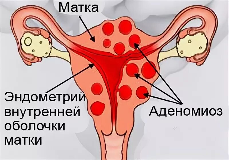 Аденомиоз диффузные изменения. Аденомиоз диффузные изменения