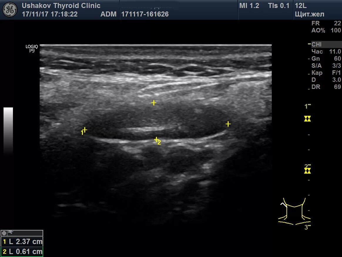 Лимфоузлы щитовидной железы на УЗИ. УЗИ лимфатических узлов шеи. Лимфатический узел щитовидной железы УЗИ. УЗИ щитовидной железы с региональными лимфатическими узлами. Щитовидная железа узи лимфоузлы