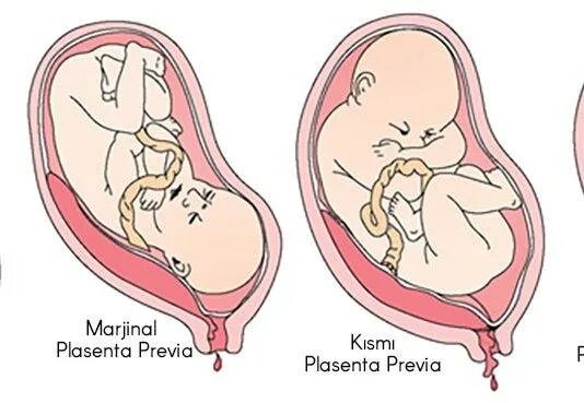 Тазовое предлежание плода кесарево. Краевое расположение хориона. Кесарево сечение при предлежании плаценты. Краевое прикрепление хориона 12 недель. Краевое предлежание хориона 13 недель.