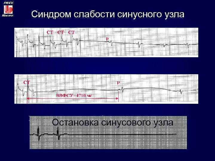 Дисфункция синусового узла что это. Синдром слабого синусового узла ЭКГ. ЭКГ признаки слабости синусового узла. ЭКГ при слабости синусового узла. Слабость синусового узла на ЭКГ.