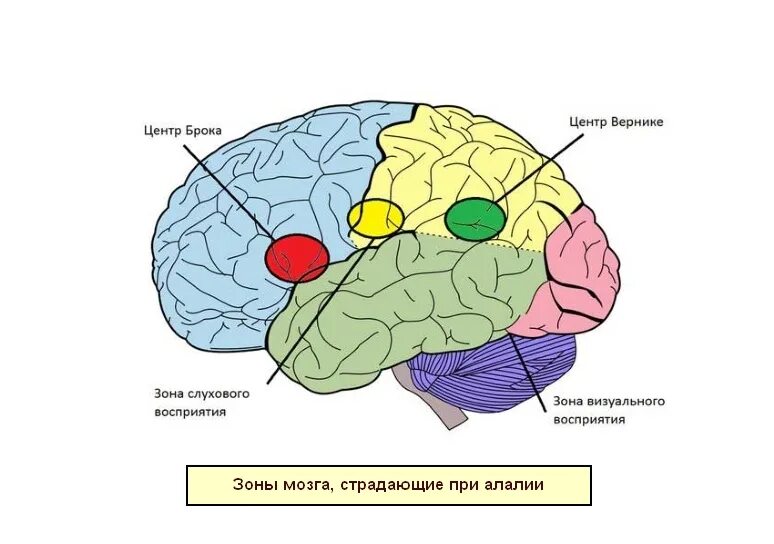 Слуховой центр коры мозга. Мозг зоны Брока и Вернике. Речевые зоны коры головного мозга Брока. Моторная алалия локализация поражения. Моторная алалия зоны поражения мозга.