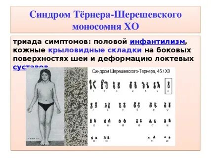 Симптомы шерешевского тернера