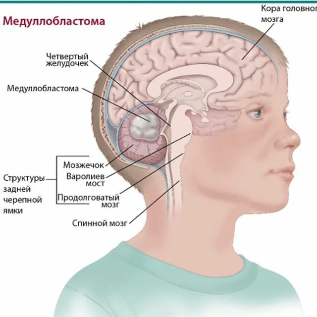 клинические проявления опухоли мозжечка:. кистозная опухоль головного мозга. при опухоли мозжечка возникают симптомы:. опухоль левой гемисферы мозжечка. инфаркт мозжечка кт.
