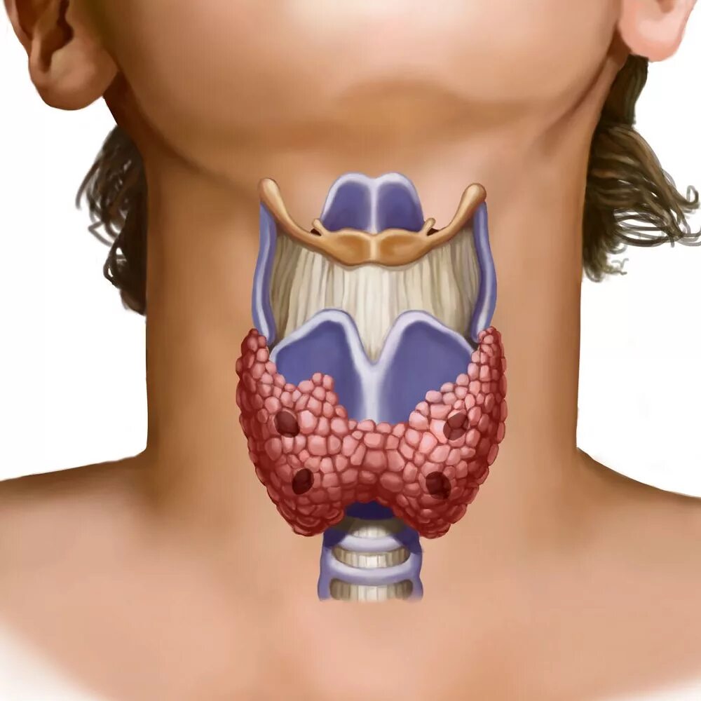 Что такое щитовидная железа. Зоб щитовидной железы болезни. Зоб щитовидной железы симптомы.