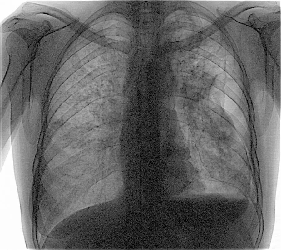 Легкие человека с туберкулезом. Крупнокадровая флюорография при туберкулёзе. Туберкулёз на флюорографии. Флюорография туберкулез легких. Снимок флюорограмма туберкулез.