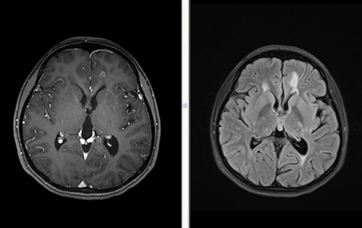 Снимки мрт головного мозга норма. MRT головного мозга Norma. Рассеянный склероз на кт. Снимок мрт головного мозга в норме. Разница кт и кт с контрастом