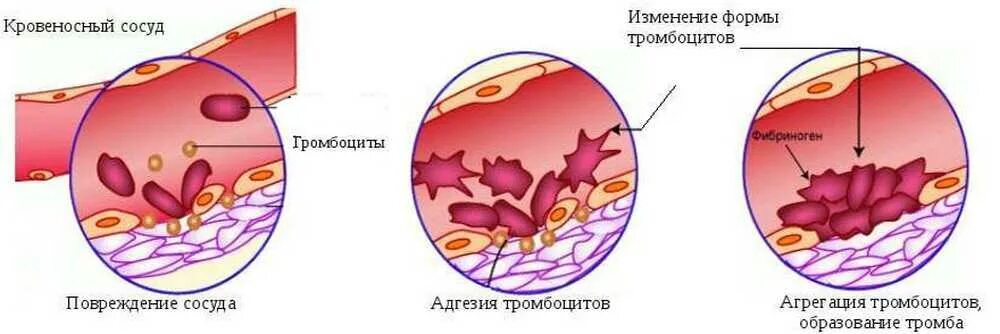 Стадии образования тромба схема. Механизм образования тромба схема. Тромбоциты образование тромба. Стадии образования тромба при повреждении сосуда. Образование тромба попадание факторов