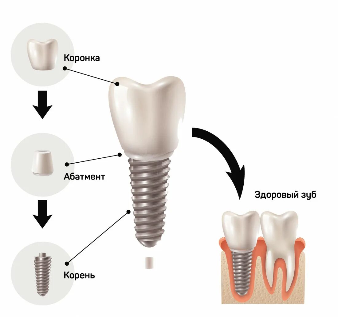 Имплант st3510sm чертеж. Этапы имплантации зубов.