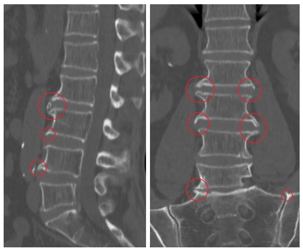Симптомы поясничного крестцового отдела позвоночника. Деформирующий спондилез грудного отдела позвоночника рентген. Деформирующий спондилез грудного отдела рентген. Спондилоартроз грудного отдела на рентгене. Спондилез поясничного отдела рентген.