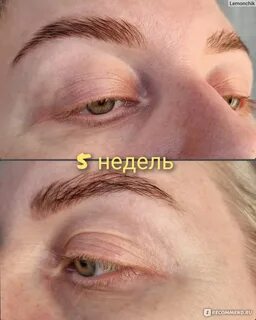 Укрепление бровей