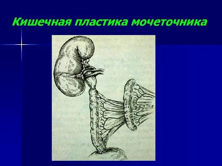 Травма мочеточника. Пластика мочеточников Оперативная хирургия. Пластика мочеточника топографическая анатомия. Кишечная пластика мочеточника. Пластика мочеточника по Боари.