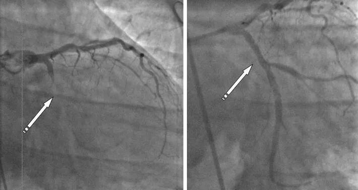 После стентирование самолет. Коронарография инфаркт миокарда. Коронарография окклюзия. Коронарография стеноз ствола. Субокклюзия коронарной артерии.