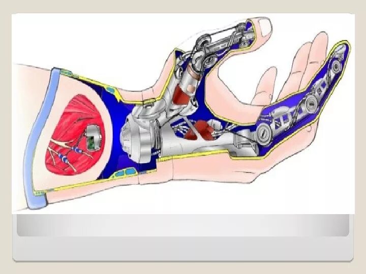 Бионические протезы bebionic hand. Бионическая рука веном снейка. Montagem bionics especial 2. Montagem bionics especial 2. Montagem bionics especial 2.