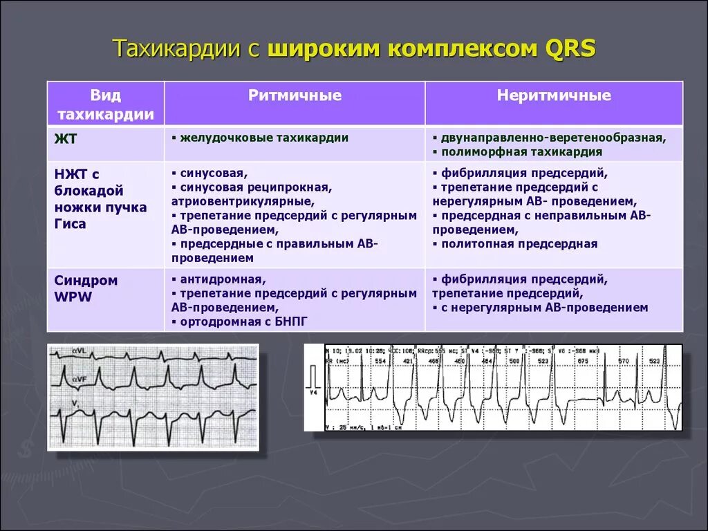 Тахикардия осложнения. Тахикардия с уширенными комплексами QRS:. Пароксизмальная тахикардия с широким комплексом QRS. Пароксизмальная наджелудочковая тахикардия ЭКГ. Пароксизмальная тахикардия на ЭКГ С широкими комплексами.