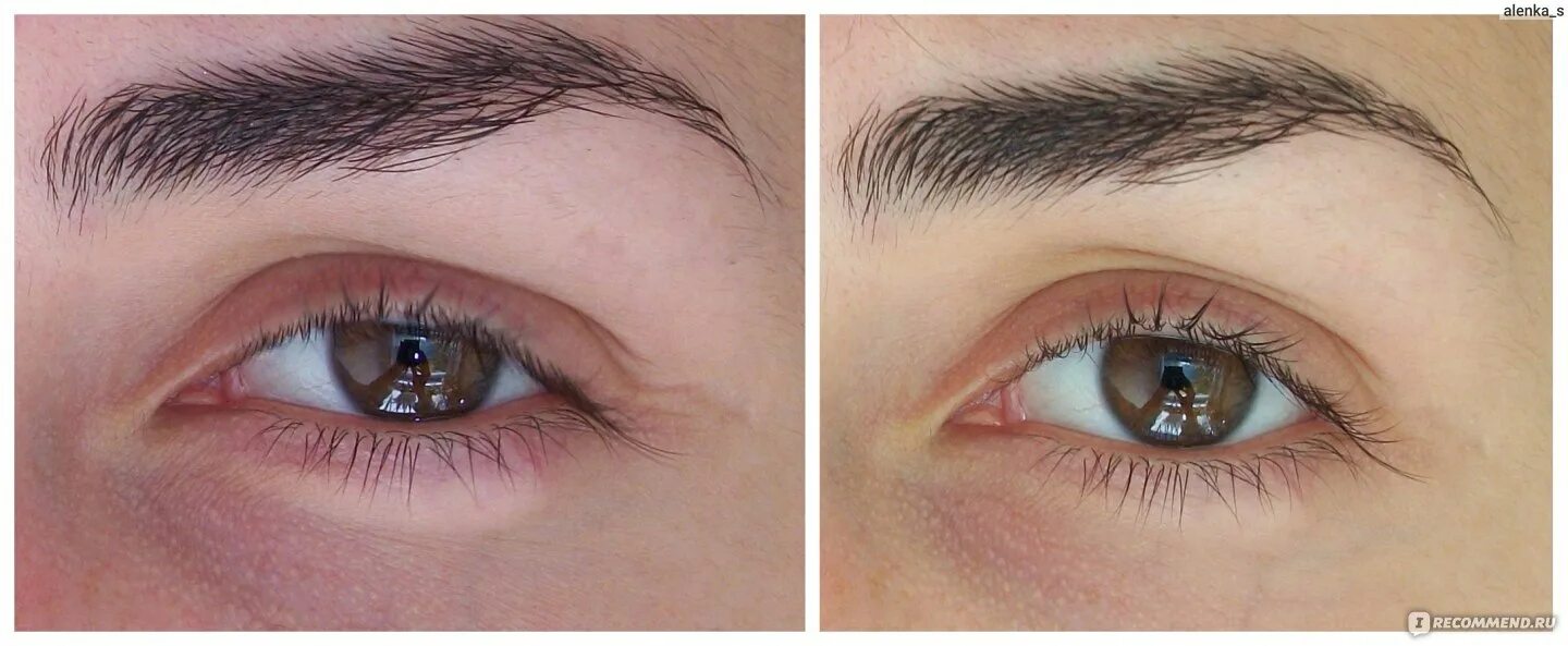 Неудачная ринопластика. Дипроспан в рубец под глазом. Дипроспан сусп. Дипроспан 7мг/мл 1мл сусп. Уколы дипроспана в нос после ринопластики.