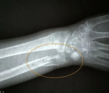 Broken right