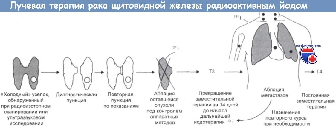 Лучевая терапия при онкологии щитовидки. Терапия радиоактивным йодом щитовидной железы. Радиооблучение щитовидной железы. Облучение щитовидной железы радиоактивным йодом.