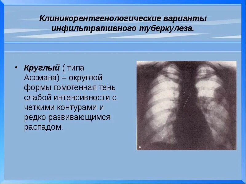 Инфильтративный туберкулёз инфильтраты. Округлый инфильтративный туберкулез рентген. Инфильтрационный туберкулез рентген. Формы инфильтративного туберкулеза легких.