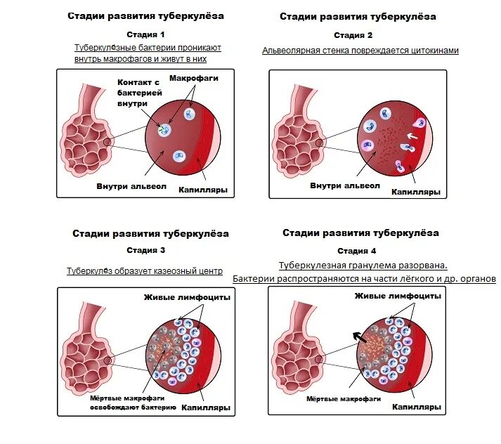 Фазы развития туберкулеза легких. Стадии развития первичного туберкулеза. Типы воспалительных реакций при туберкулезе. Патогенез туберкулёза лёгких.