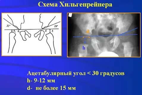 Углы суставов ребенка норма
