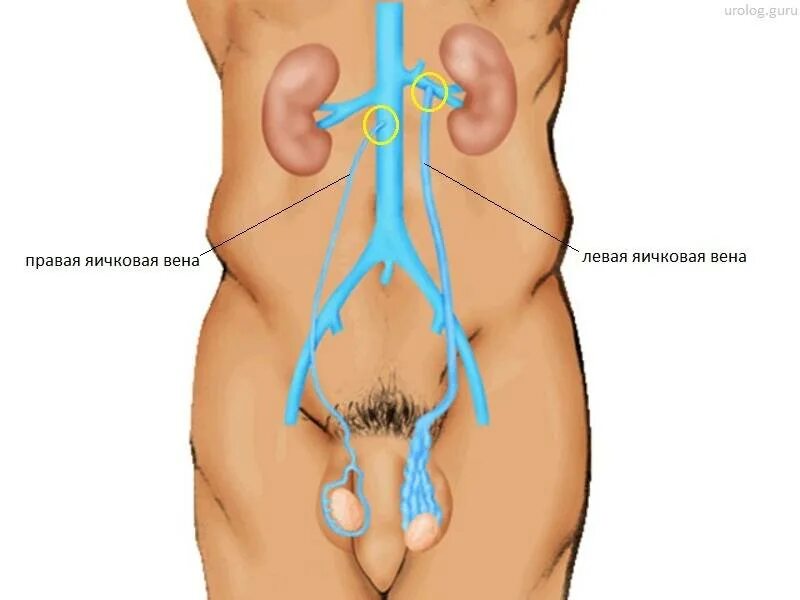 Ниже яиц у мужчин. Шрам варикоцеле Мармара. Варикоцеле расширение вен. Варикоцеле семенного канатика. Варикоз вен семенного канатика.