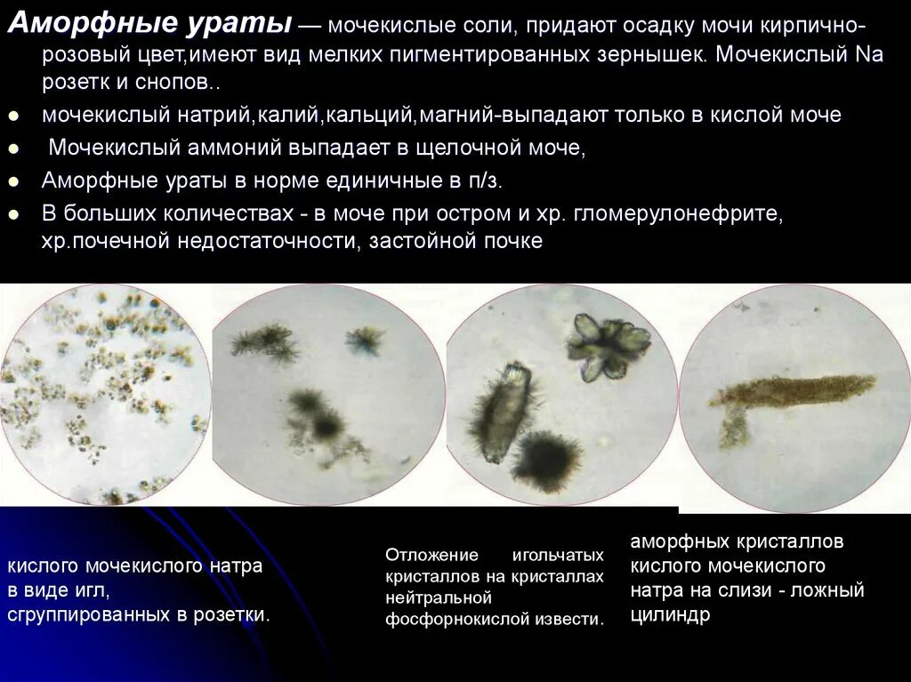 Высокая соль в моче. Кислый мочекислый аммоний в моче. Соли мочекислый аммоний. Мочекислый аммоний в моче у кошки. Кислый мочекислый натрий в моче.