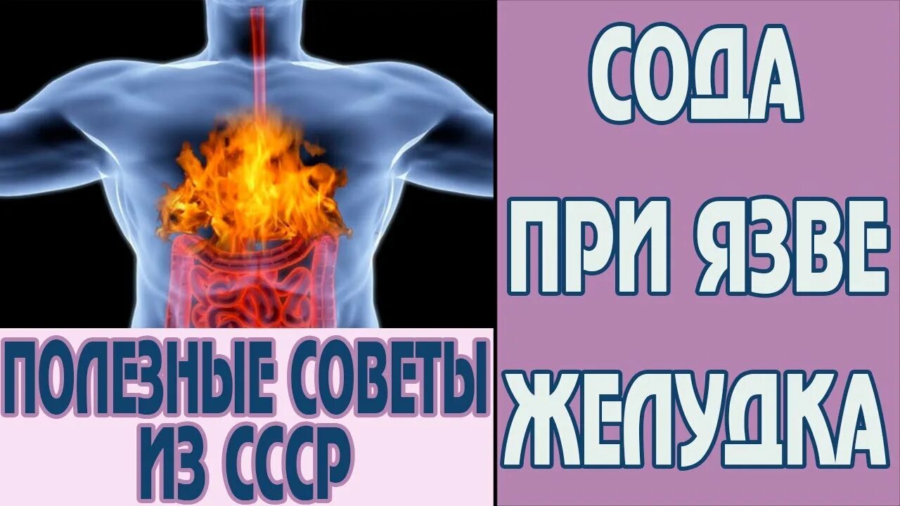 Сода от изжоги. Сода при язве. Сода при язвенной болезни. Сода помогает при изжоге. Сода при боли в желудке