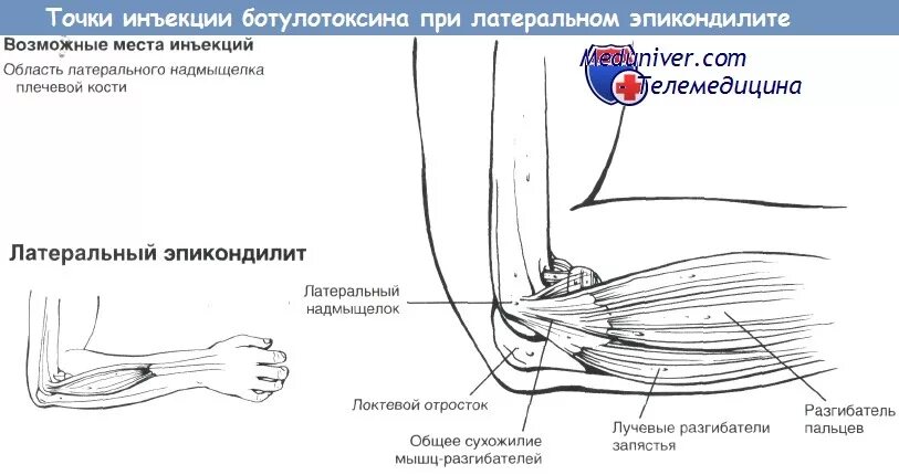 Блокада при эпикондилите локтевого сустава. Латеральный эпикондилит локтевого сустава блокада. Эпикондилит локтевого сустава мрт. Латеральный эпикондилит сухожилие. Точка уколова